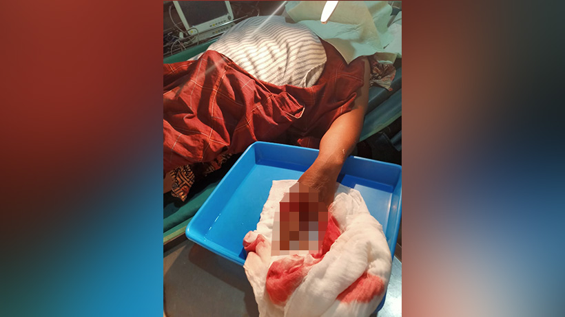 Suami Bacok Istri Di Malang, Kepala Luka, Jemari Tangan Kiri Terputus