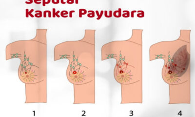 Target Indonesia 2026: Turunkan Angka Kematian Kanker Payudara 2,5% Per Tahun!