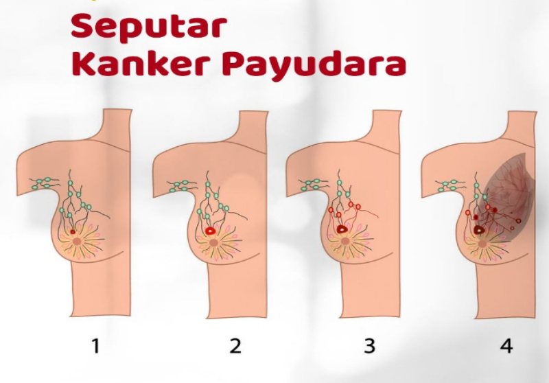 Target Indonesia 2026: Turunkan Angka Kematian Kanker Payudara 2,5% Per Tahun!